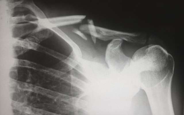 X-Ray of fractured collarbone